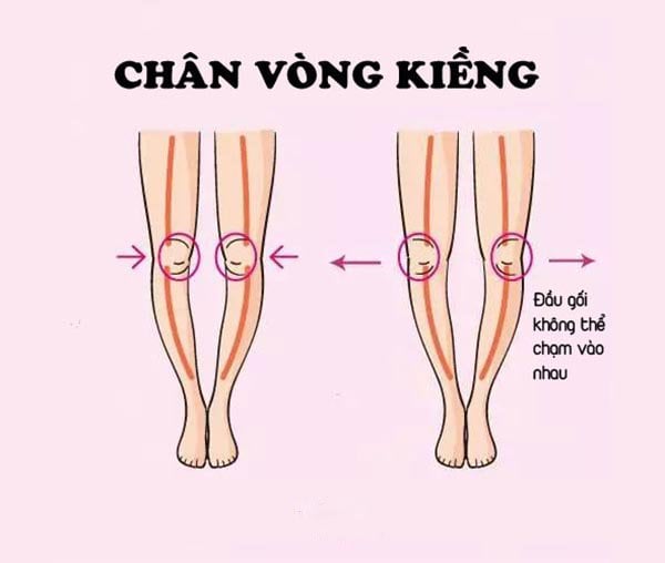 Chân vòng kiềng