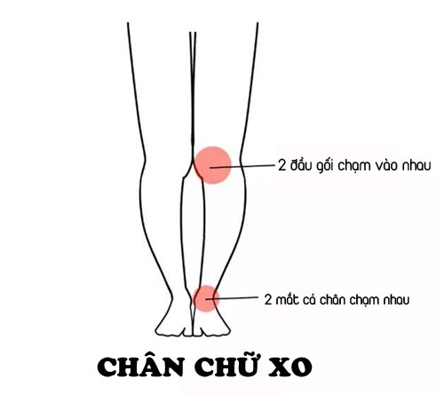 Những bài tập khắc phục chân vòng kiềng lâu năm hiệu quả nhất 135372