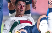 Ronaldo chảy máu đầy ghê rợn khi thi đấu, hình ảnh khiến fan không khỏi xót xa