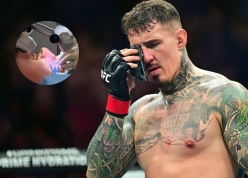 Tom Aspinall phẫu thuật mắt thành công, chưa ấn định thời điểm trở lại UFC