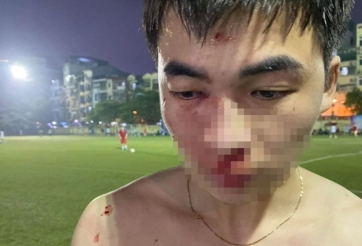 Nam thanh niên tố bị đánh gãy mũi trên sân phủi ở Hà Nội