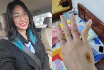 Sao bóng chuyền Geleximco Thái Bình khiến NHM sốc với bàn tay dị dạng