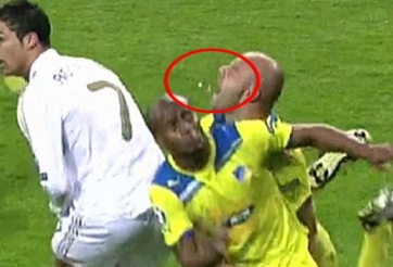 Video hài hước: Tổng hợp những pha tai nạn gẫy răng như Mikael Arteta