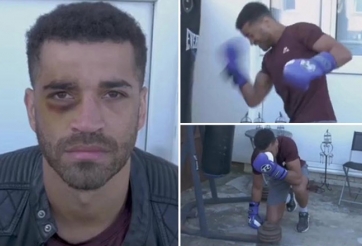Rảnh rỗi, nhà vô địch Boxing tự đấm tím mắt chính mình