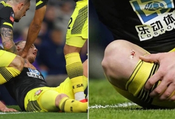 Kinh hoàng: Sao Tottenham đạp lòi xương cầu thủ Southampton