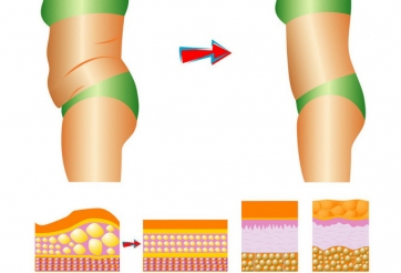 Mẹo giảm mỡ bụng “thần tốc” tại nhà chỉ với 3 bước đơn giản