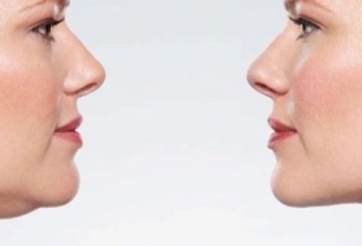 Cách giảm béo mặt và cằm tự nhiên hiệu quả