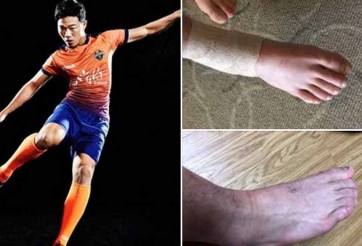 Gangwon khoe hình ảnh chấn thương của Xuân Trường