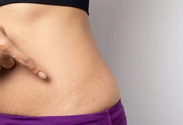 Bạn có thể ngăn ngừa 'rạn da' khi giảm cân bằng cách nào?