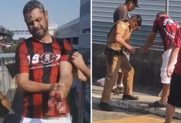 CĐV trả giá cực đắt khi pháo sáng phát nổ trên tay