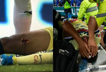 Cựu sao Barca dính chấn thương kình hoàng tại quê nhà