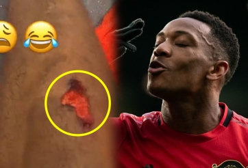 Martial 'khoe' vết thương sau chiến thắng trước Man City