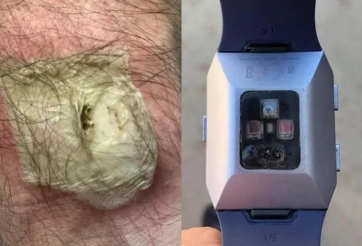 Bỏng nặng do đồng hồ thông minh phát nổ trên tay