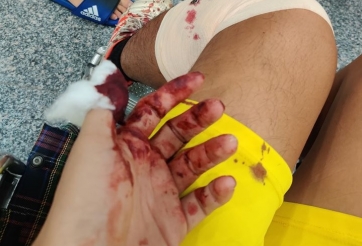 Cầu thủ phủi bị đánh trọng thương, phải nhập viện khẩn cấp?