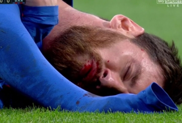 Messi gẫy răng sau pha vung cùi chỏ của Marcelo