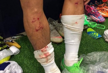 Ống đồng của Văn Kiên ‘in’ 4 vết đinh giày của Quế Ngọc Hải