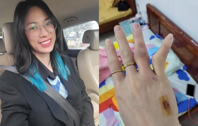 Sao bóng chuyền Geleximco Thái Bình khiến NHM sốc với bàn tay dị dạng