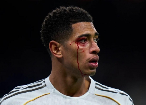 Jude Bellingham rách mắt, vẫn bị trọng tài phạt thẻ vàng