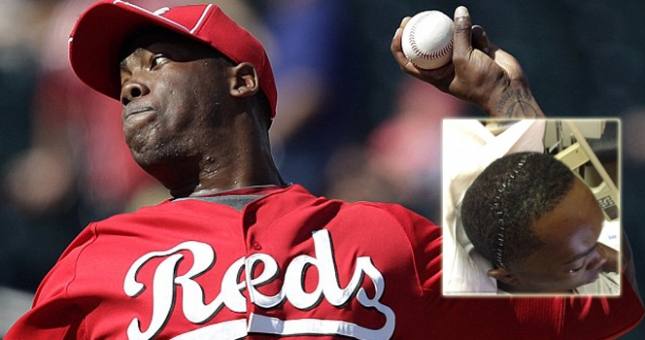 Cú đánh kinh hoàng khiến sao bóng chày vỡ xương mắt và mũi