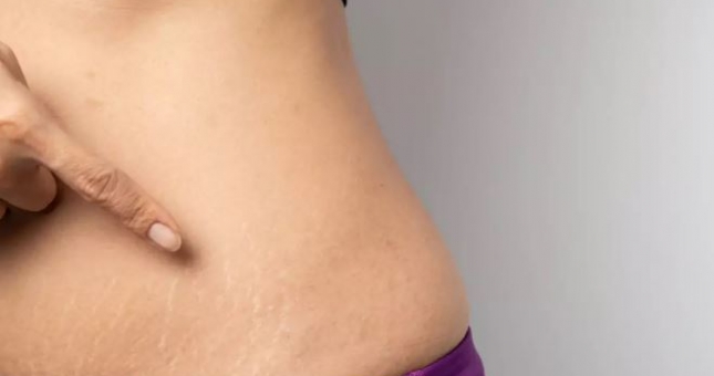 Bạn có thể ngăn ngừa 'rạn da' khi giảm cân bằng cách nào?