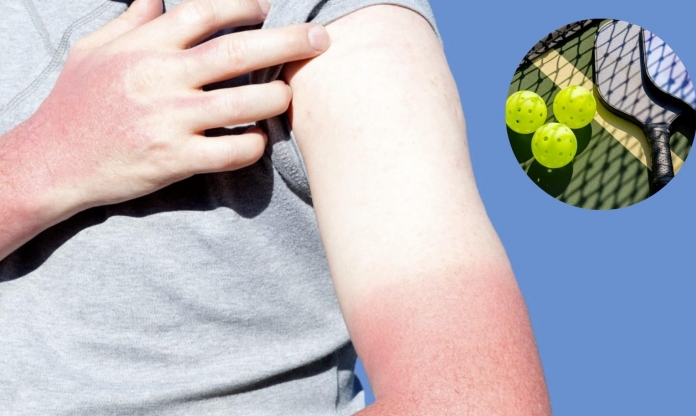 Chị em than chơi pickleball khiến da sạm, nám: Nguyên nhân đến từ đâu?