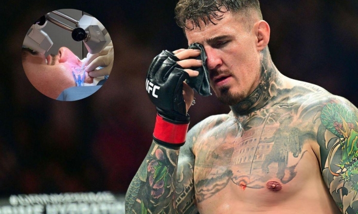 Tom Aspinall phẫu thuật mắt thành công, chưa ấn định thời điểm trở lại UFC