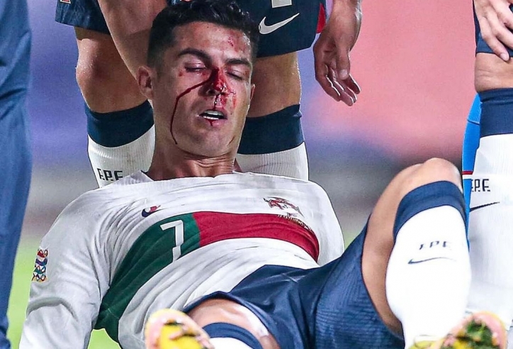 Ronaldo chảy máu đầy ghê rợn khi thi đấu, hình ảnh khiến fan không khỏi xót xa