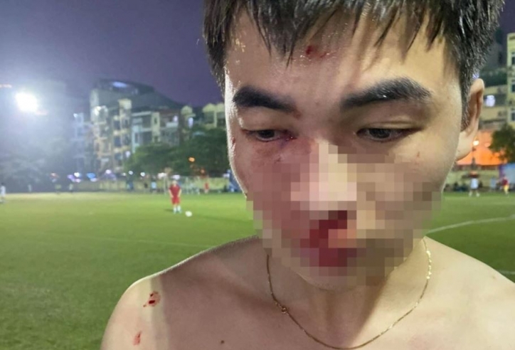 Nam thanh niên tố bị đánh gãy mũi trên sân phủi ở Hà Nội