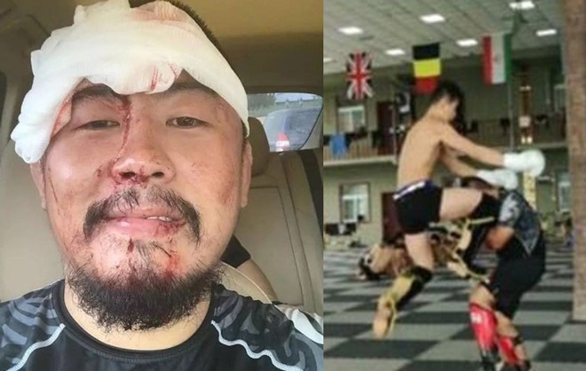 Nhận lời thách đấu, 'gã điên' MMA Trung Quốc bị đánh phải khâu 26 mũi
