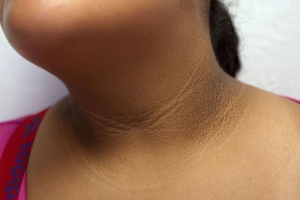 acanthosis-nigricans-term-darken-1-1713585269.jpg