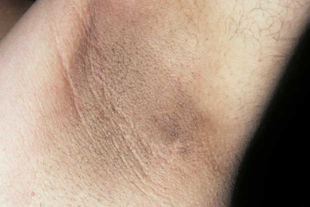 acanthosis-nigricans-term-darken-1713585269.jpg