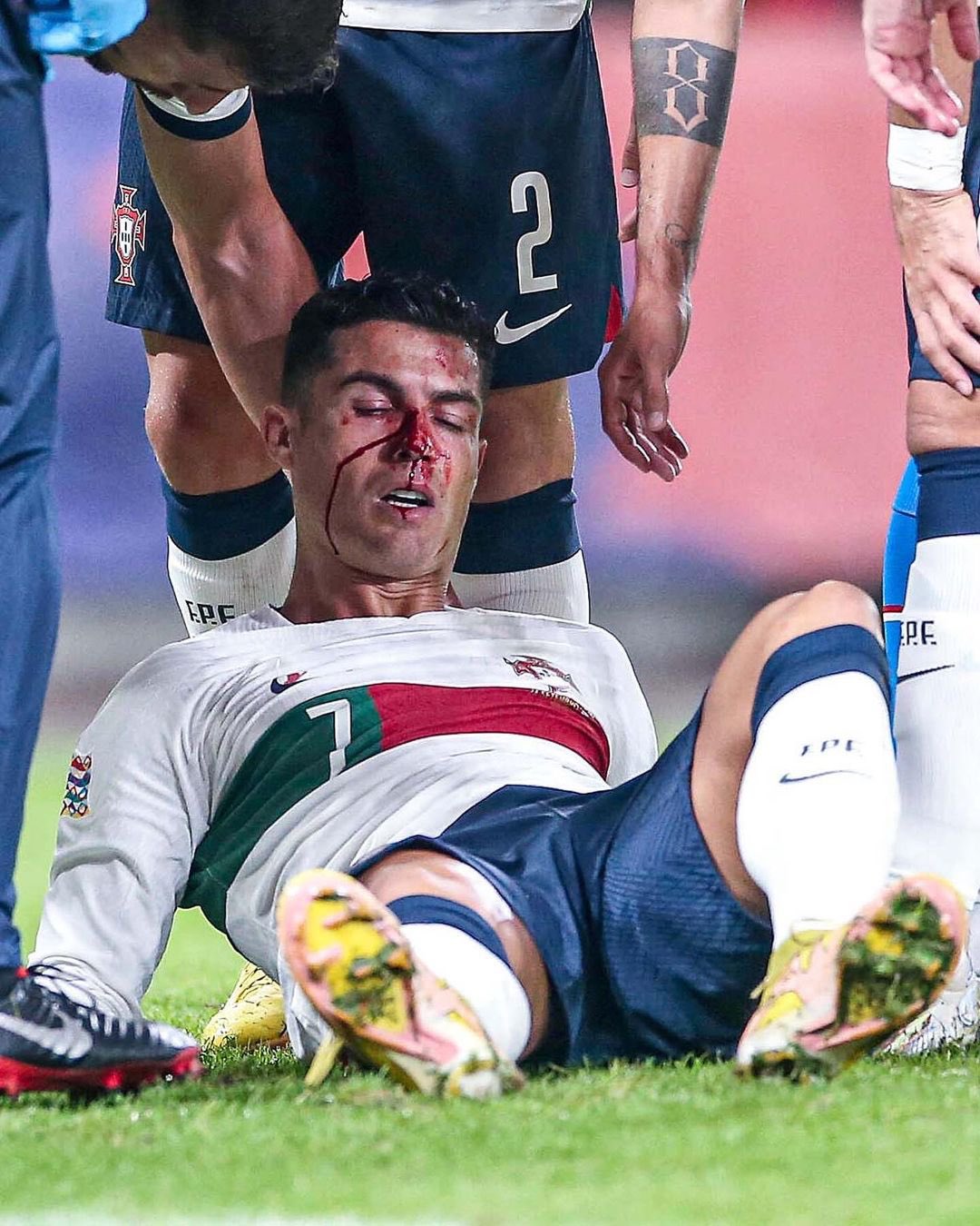 Ronaldo chảy máu ghê rợn khi thi đấu, hình ảnh khiến fan xót xa
