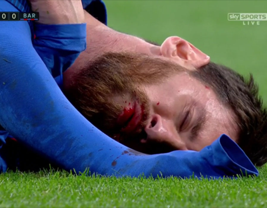 Messi đổ máu sau khi tình huống va chạm với Messi